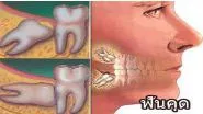 ฟันคุด.webp