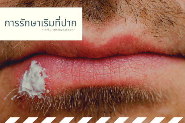 การรักษาเริมที่ปาก.png
